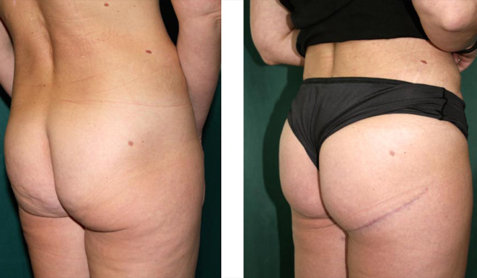 Immagine illustrativa: Gluteoplastica