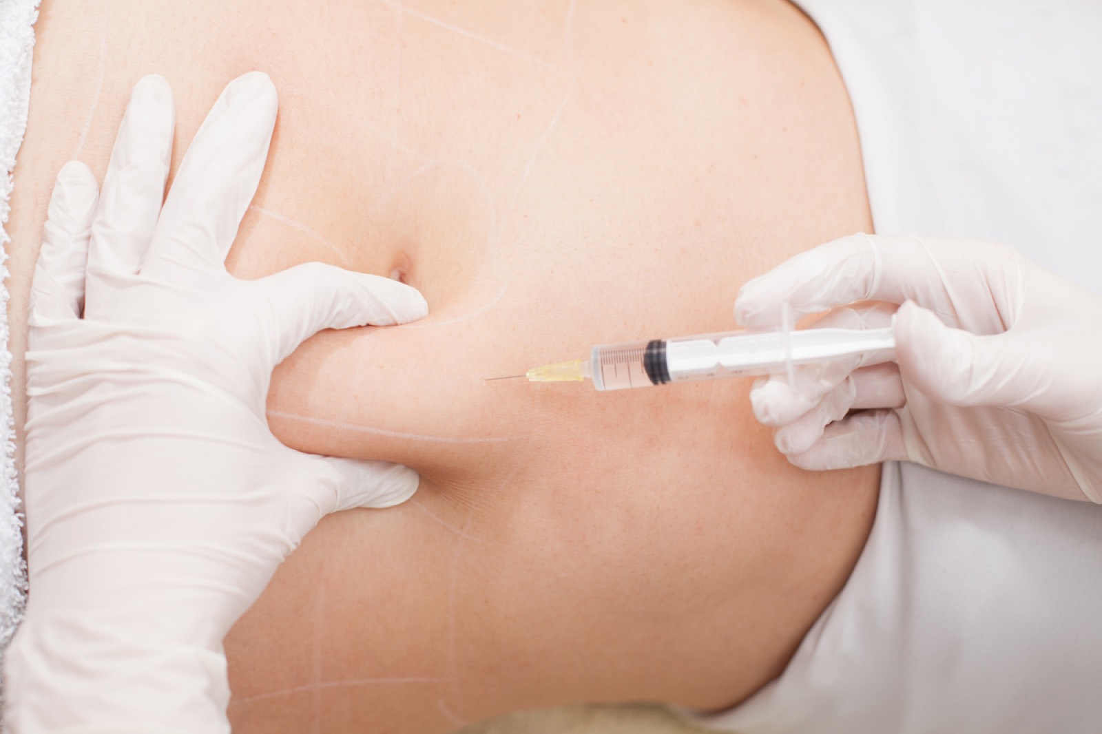 Immagine illustrativa: Subcision, per cellulite e cicatrici depresse